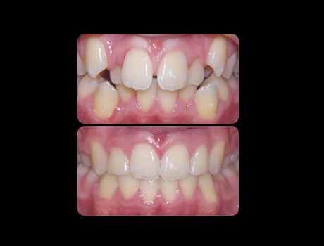 Crowding resolved in 15 months with full upper and lower braces