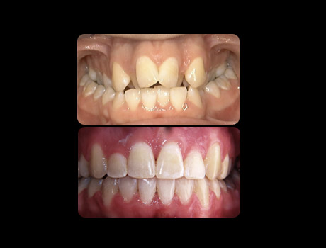 Full Braces and oral surgery