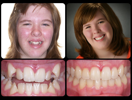 E. Erkkila was treated WITHOUT surgery in 42 months TX time