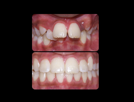 Crowding resolved in 23 months with full upper and lower braces