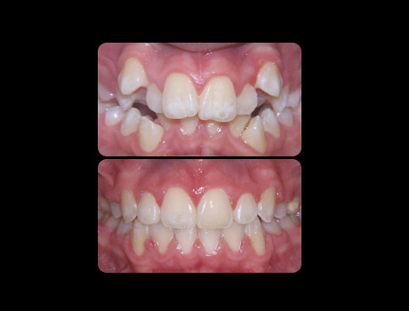 Crowding resolved in 20 months with full upper and lower braces