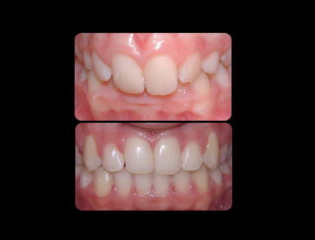 Deep Bite resolved in 31 months with full upper and lower braces