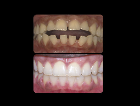 Openbite resolved in 23 months with full upper and lower braces